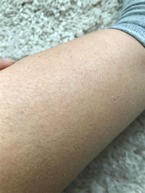 skin   legs  scaly  dry skin concern