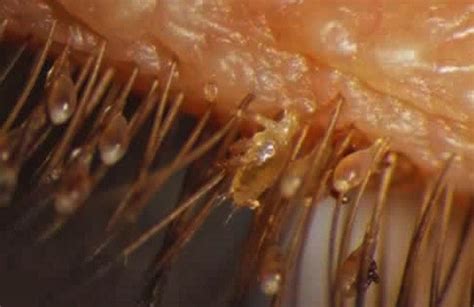 electron microscopy  imgur eye mites eyelash mites parasite