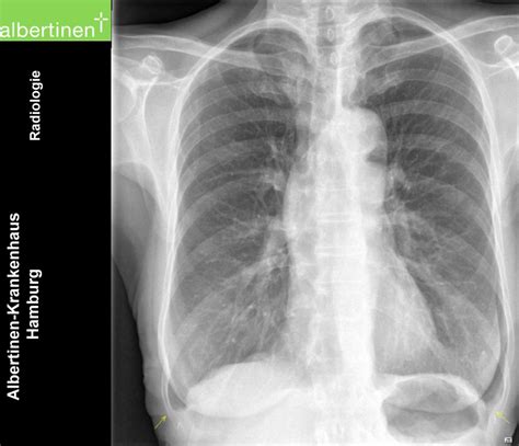 roe thorax emphysem pa doccheck