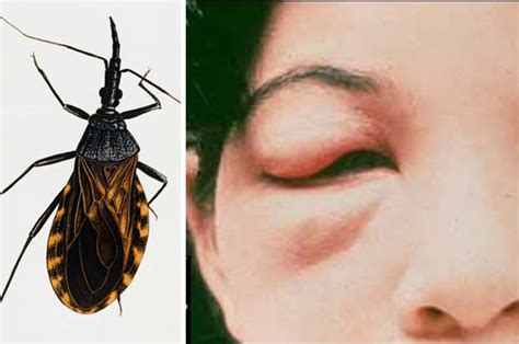 Fears Over Lethal Insect Kissing Bug Insect In The Uk Daily Star