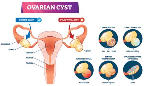 ovarian cystectomy ovarian cyst removal and complications health plus