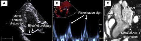 Mitral Valve Prolapse Related Factors Detected By Echocardiography And