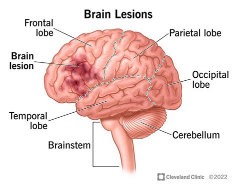 Brain Lesions What They Are Causes Symptoms And Treatment