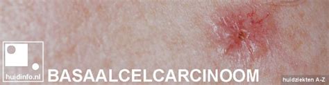 basaalcelcarcinoom huidkanker nummer een huidinfonl dermatoloog