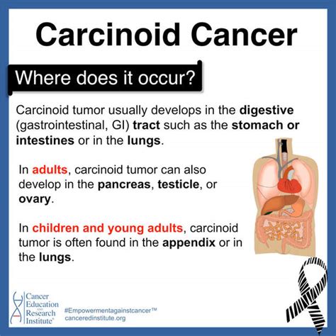 Carcinoid Cancer Cancer Education And Research Institute