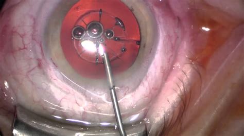 Femtosecond Laser Assisted Cataract Surgery With Femto Ldv
