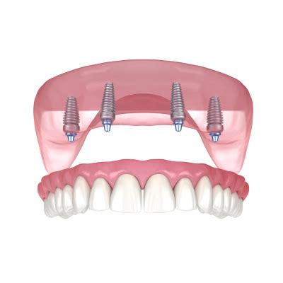 implants cost sunflower dental spa