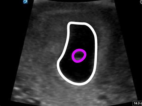 7 weeks pregnant intrauterine pregnancy critical care sonography