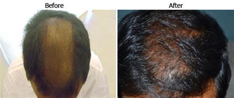 hair regrowth treatment delhi chennai bangalore kolkata india dhi international