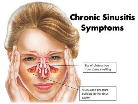 chronic sinusitis symptoms  treatments sggreekcom