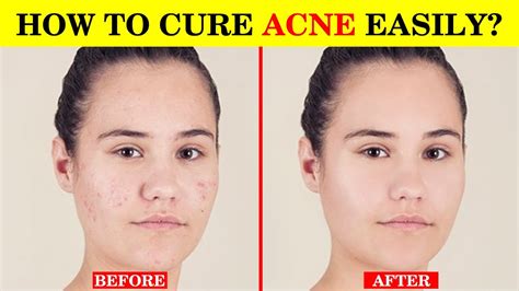 acne medicine treatment   natural acne products epic tips youtube