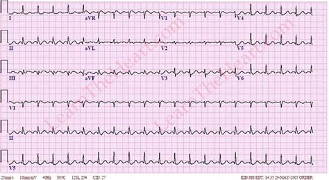 Atrial Flutter With 2 1 Conduction Example 1