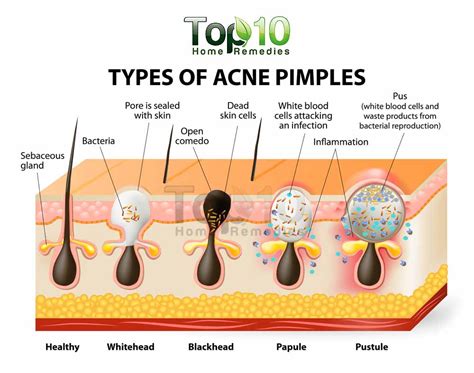 Home Remedies For Pimples Top 10 Home Remedies