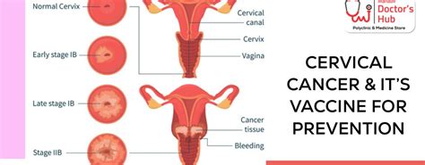 cervical cancer m doctors hub
