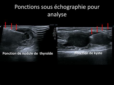 Biopsie Et Ponction à Mougins Cannes Sophia Antipolis Radiologie