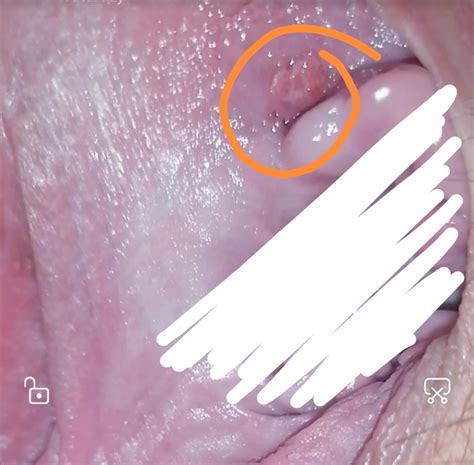 Help Please Is This Genital Warts Sexual Health