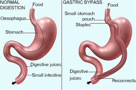 What Is The Difference Between Gastric Sleeve And Bypass