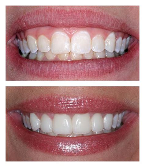 Cosmetic Gum Lift Before And After Bartholomew Dentist