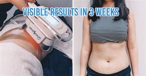 fat freezing  singapore  lose  extra weight  gained  starting work