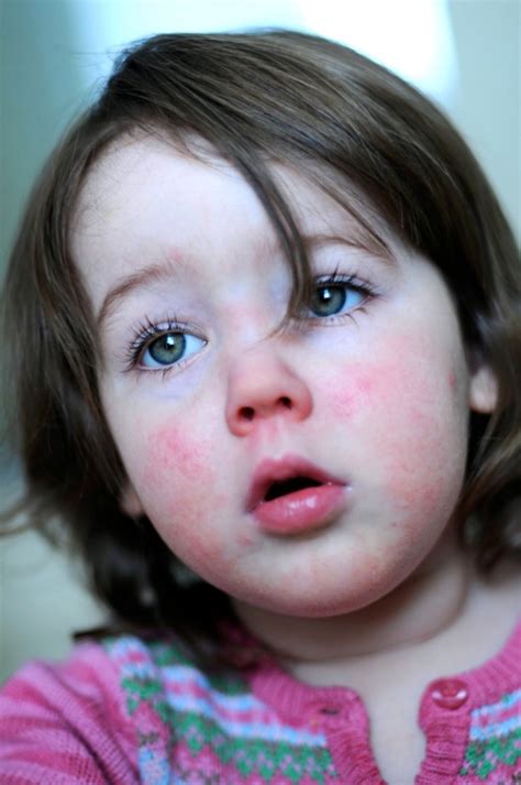 Scarlet Fever Crisis Hits Levels Not Seen For 35 Years Metro News