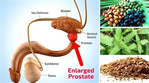 Top 5 Natural Home Remedies For Enlarged Prostate Natural Headache