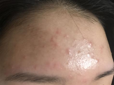 treat   skin acne racne