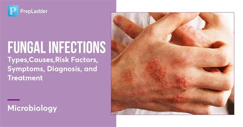fungal infections types  risk factors symptoms diagnosis