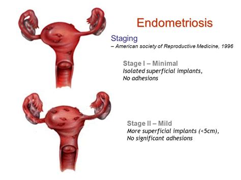 Endometriosis Menometrorrhagia Symptoms Causes And Treatment New