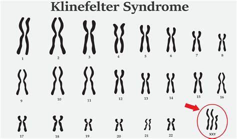 Klinefelter Syndrome As Related To Androgen Insensitivity Syndrome