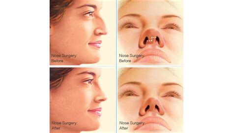 Nose Cosmetic Surgery Procedures Brigham And Women S