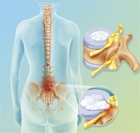 types of disc herniations bulging protruded