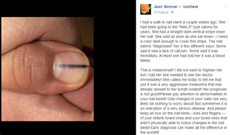 Woman Shares Warning That Black Line On Nail Could Be