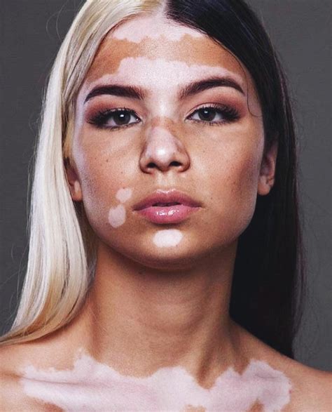 pretty girls  vitiligo google search skin model skin vitiligo
