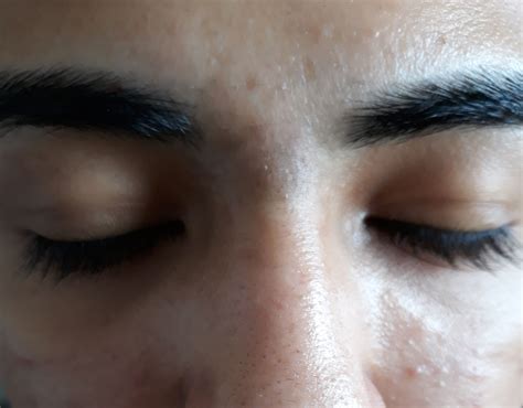 Blackhead Scars Between Eyebrows Scar Treatments Forum