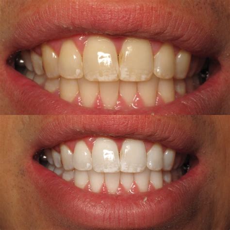 whiten teeth    enamel teeth poster