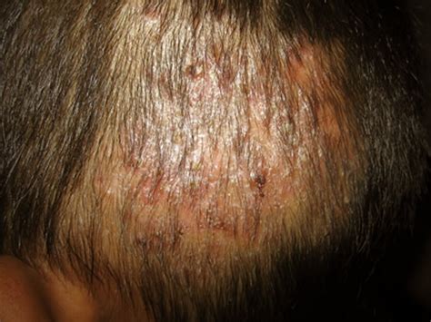 which physical findings of skin lesions suggest tinea capitis scalp