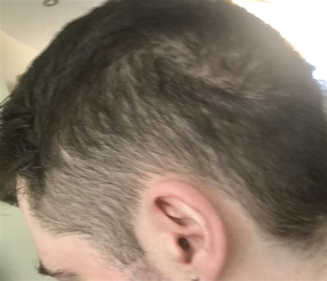 bald spot   head hairloss