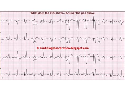 p waves    ecg  show answer  poll  p wave cardiac answers bullet