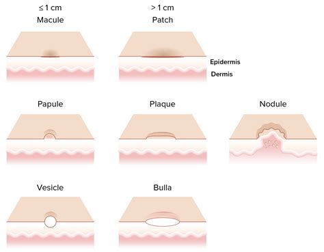 primary skin lesions concise medical knowledge
