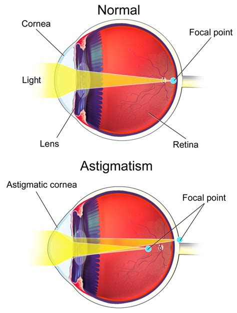 astigmatism central florida eye center p a