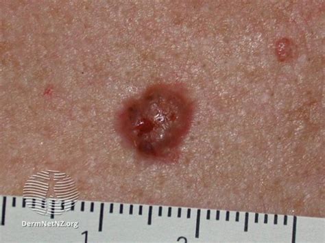 Can You Spot Which Moles Are Deadly The Skin Cancer Signs You Need To
