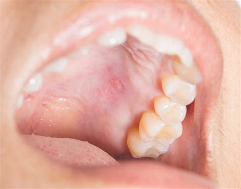 bump on the roof of the mouth 12 causes