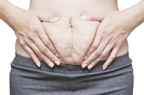 abdominal separation  pregnancy myhealth bytes