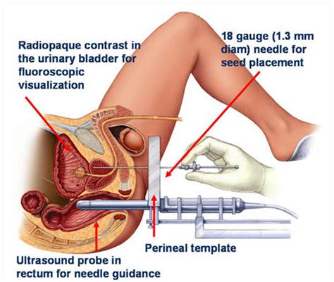 Prostate Cancer