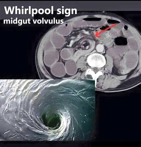 whirpool sign medical radiography radiology imaging radiology