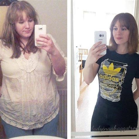 20 Inspiring Gastric Bypass Before And After