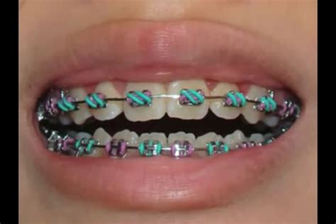 braces rubber bands german milf pics