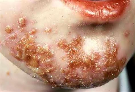 wazzup dok impetigo mamaso  talipaso
