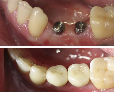 patient   missing pre molars  dental