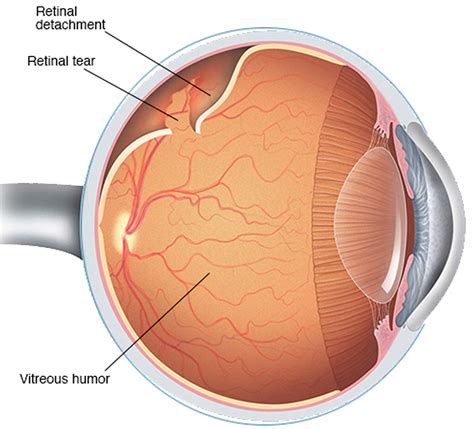 retinal detachment  signs symptoms surgery repair